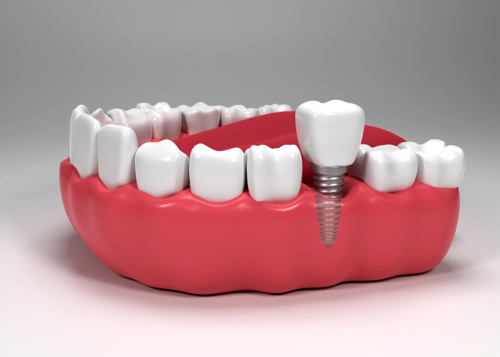 Dental Implants