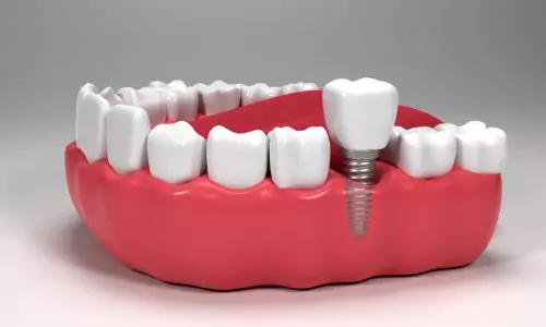 Dental Implants