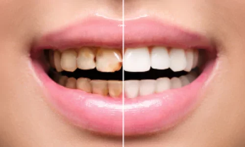 Dental Scaling & Polishing